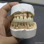 深圳义齿加工厂|义齿加工 深圳假牙加工|烤瓷牙|隐形全口义齿